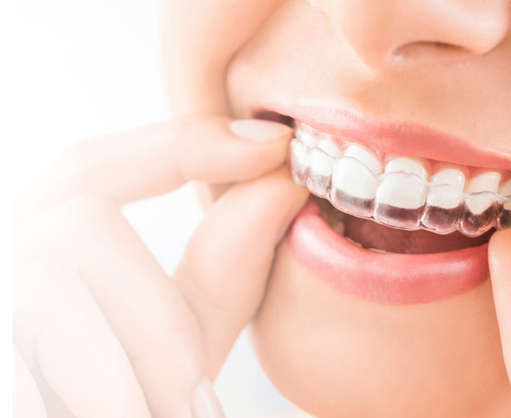 Bradford Shipley Idle Invisalign Clear Aligners Consultations Offered at Taylored Dental Care