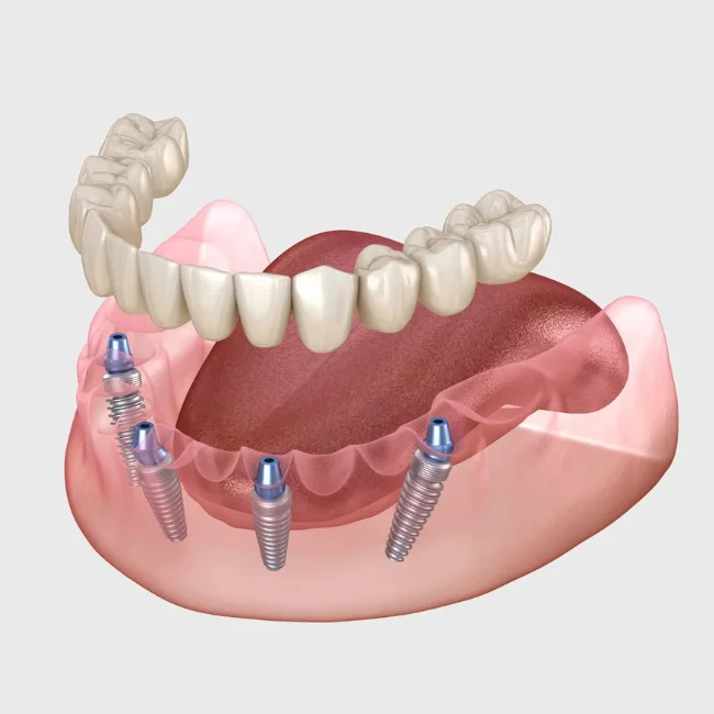 All-On-4 Dental Implants Pimlico Victoria London Treatments Now Available at McKennell Dental Practice
