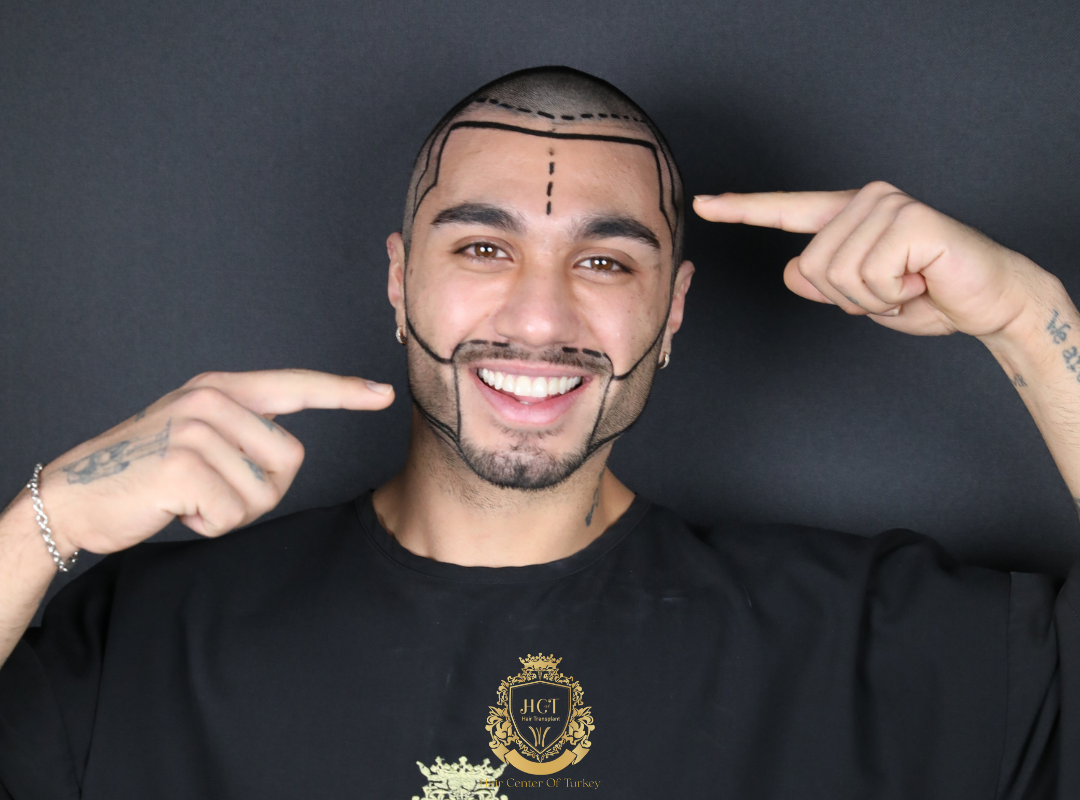 Why Hair Transplant in Turkey is So Popular: Hair Center of Turkey Experiences